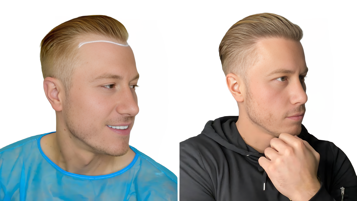 Hair Restoration